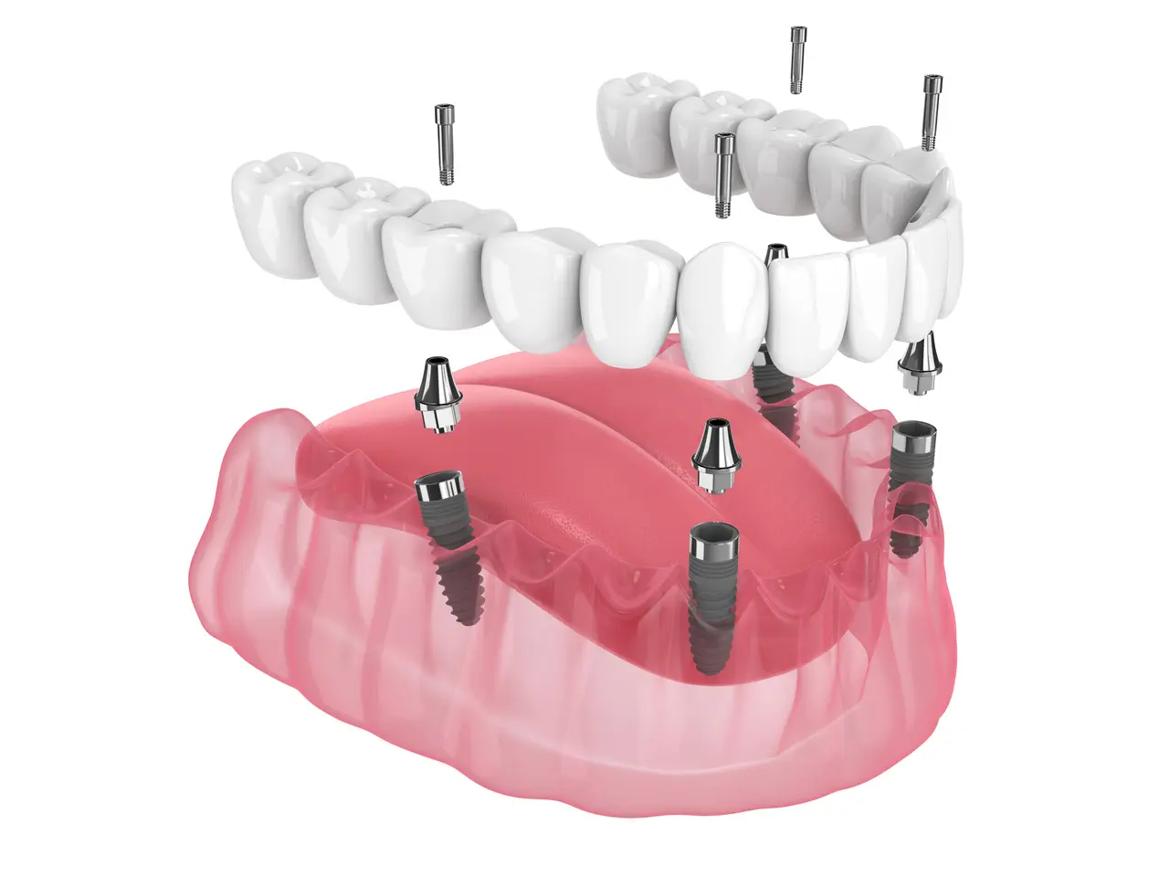 All-on-4 dental implants at Benson Hill Smiles in Renton, WA