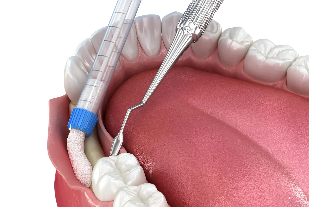 Bone grafting at Benson Hill Smiles in Renton, WA