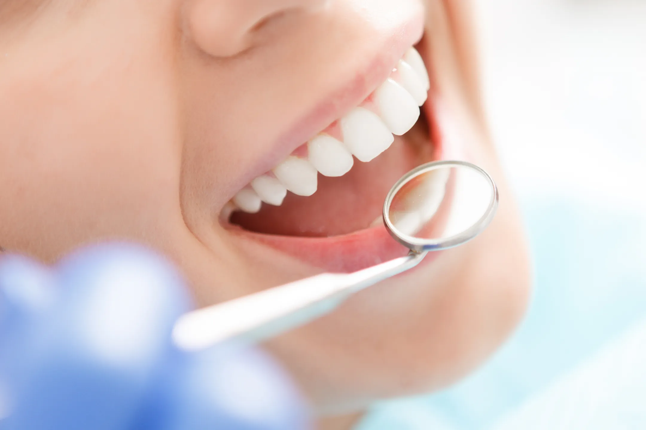 Smile makeovers at Benson Hill Smiles in Renton, WA