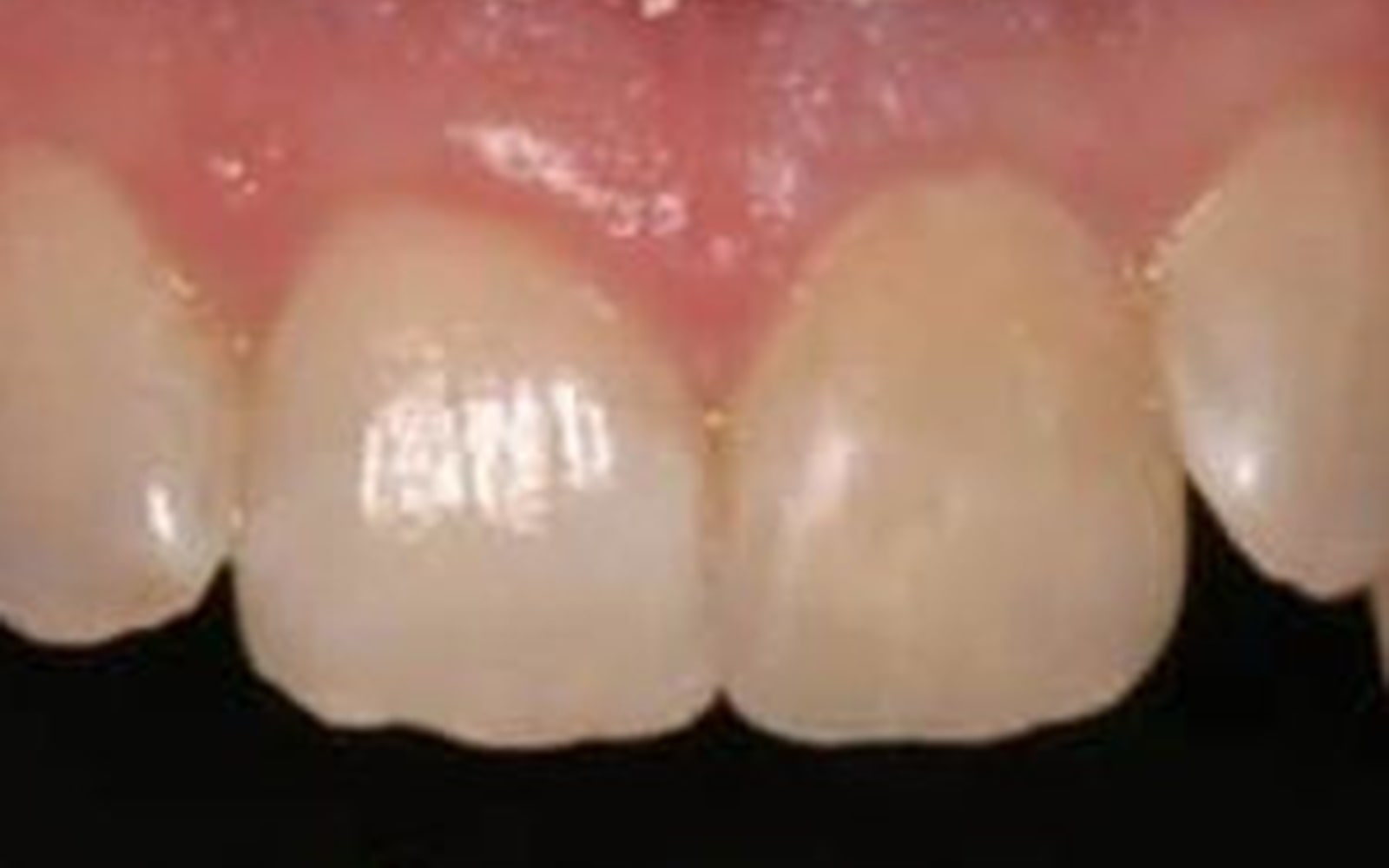 Composite Bonding case 1, after