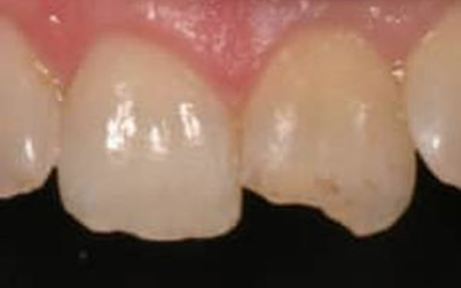 Composite Bonding case 1, before