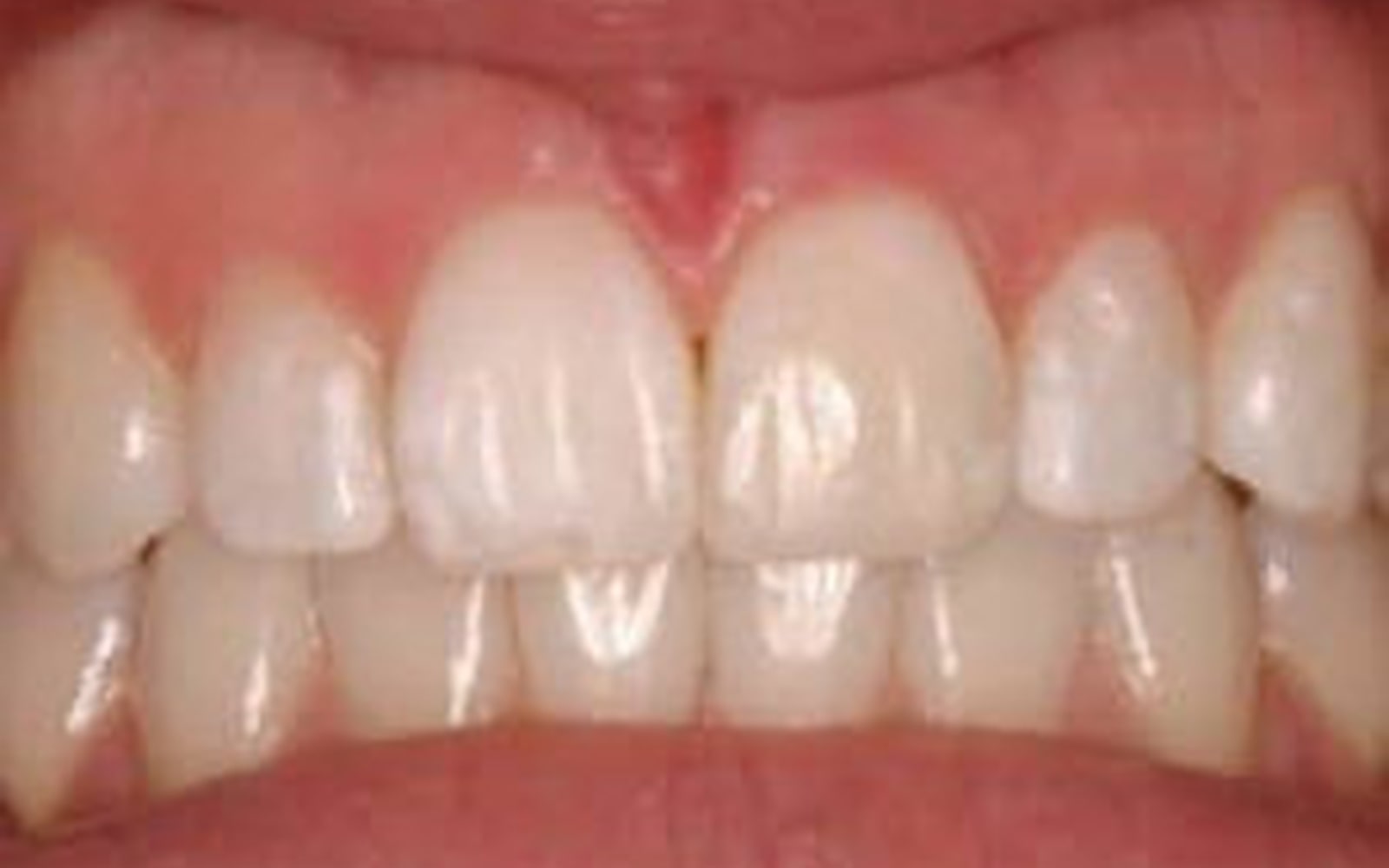 Composite Bonding case 2, after