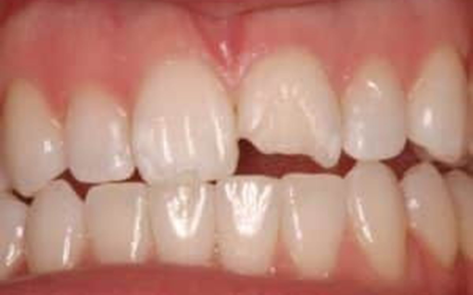 Composite Bonding case 2, before