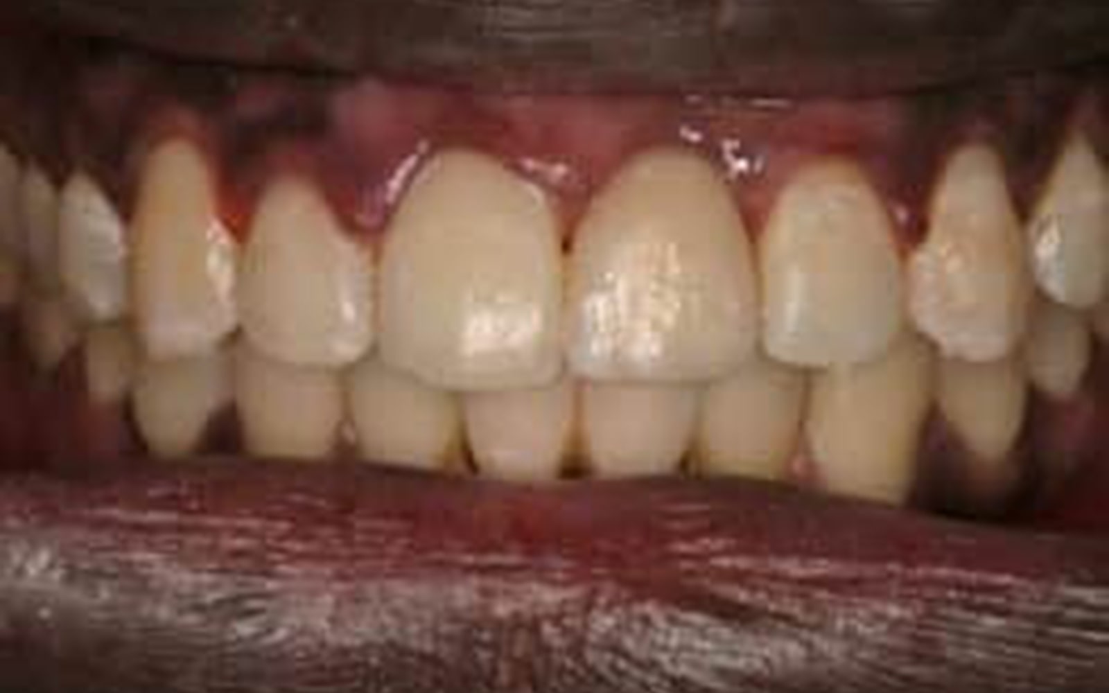 Bridges case 1, after