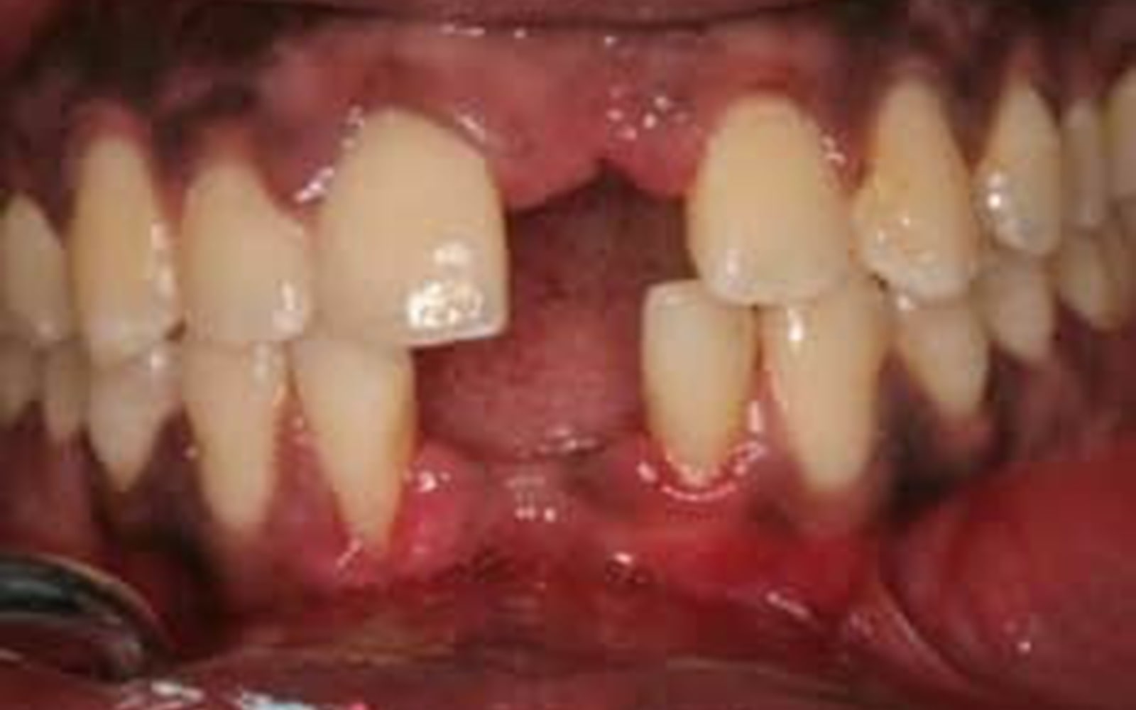 Bridges case 1, before