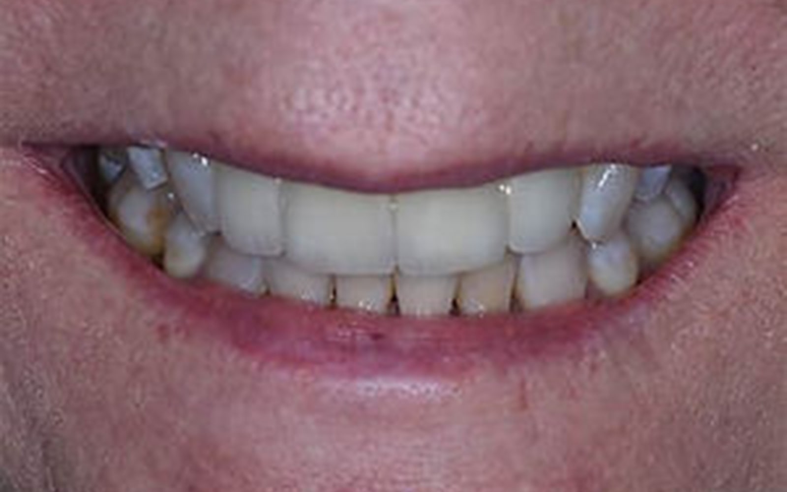 Bridges case 2, after