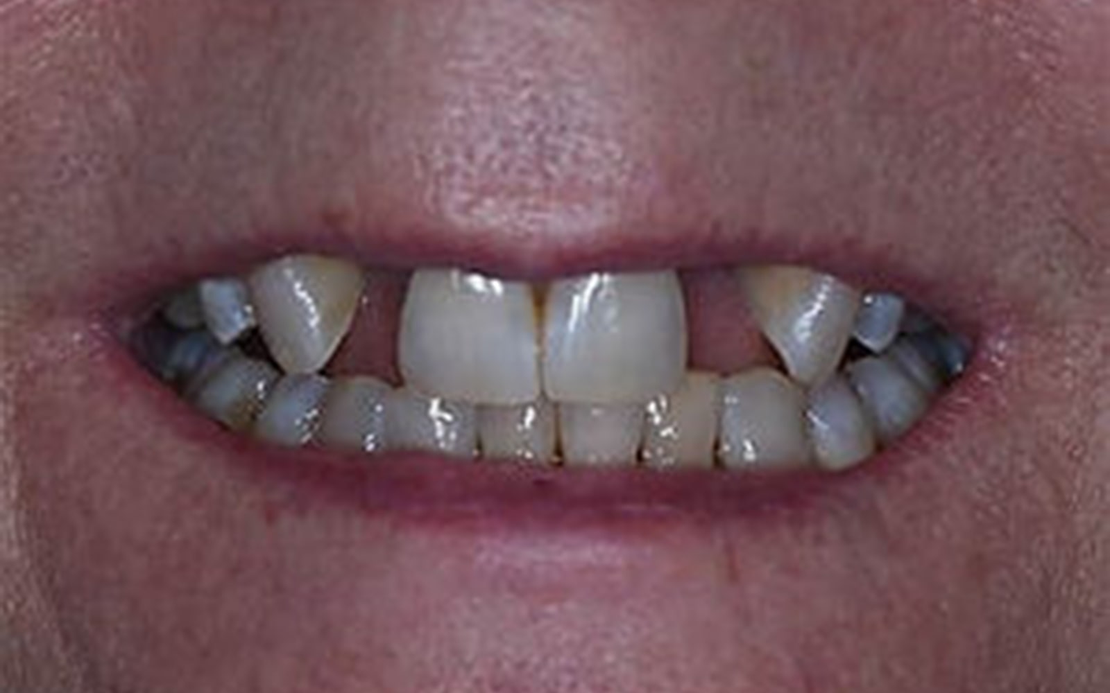 Bridges case 2, before