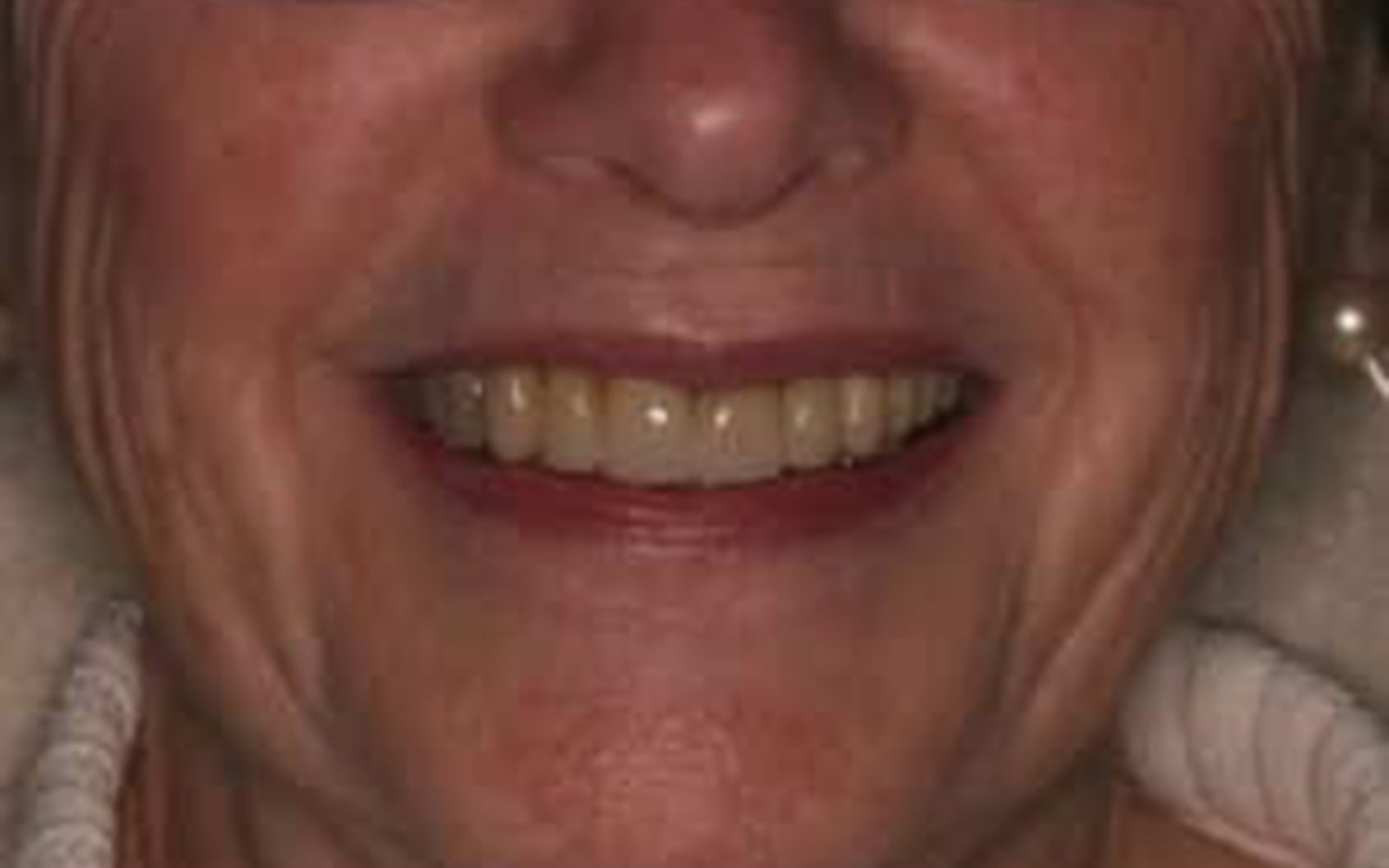 Crowns and Veneers case 1, after