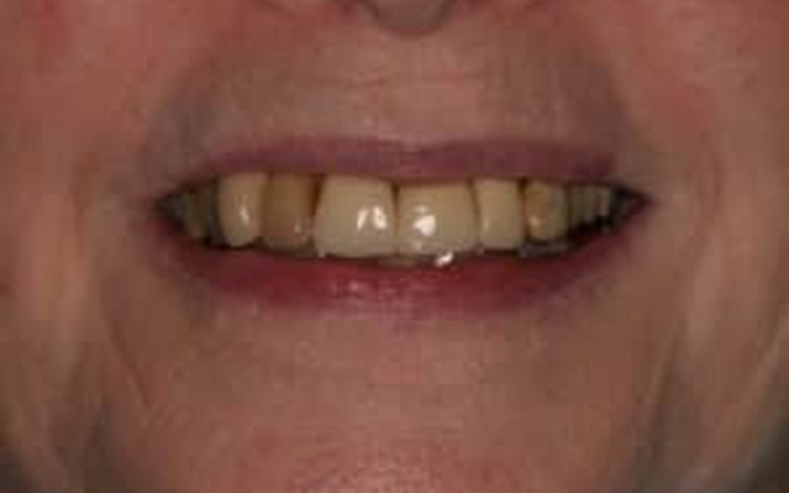 Crowns and Veneers case 1, before