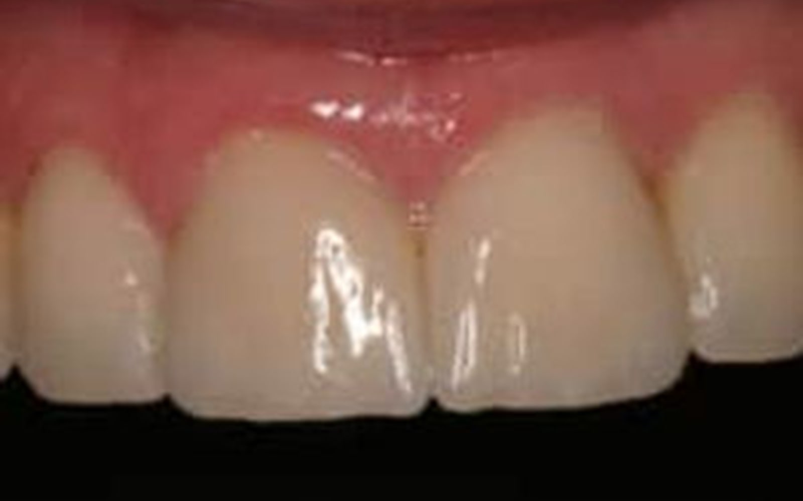Crowns and Veneers case 2, after