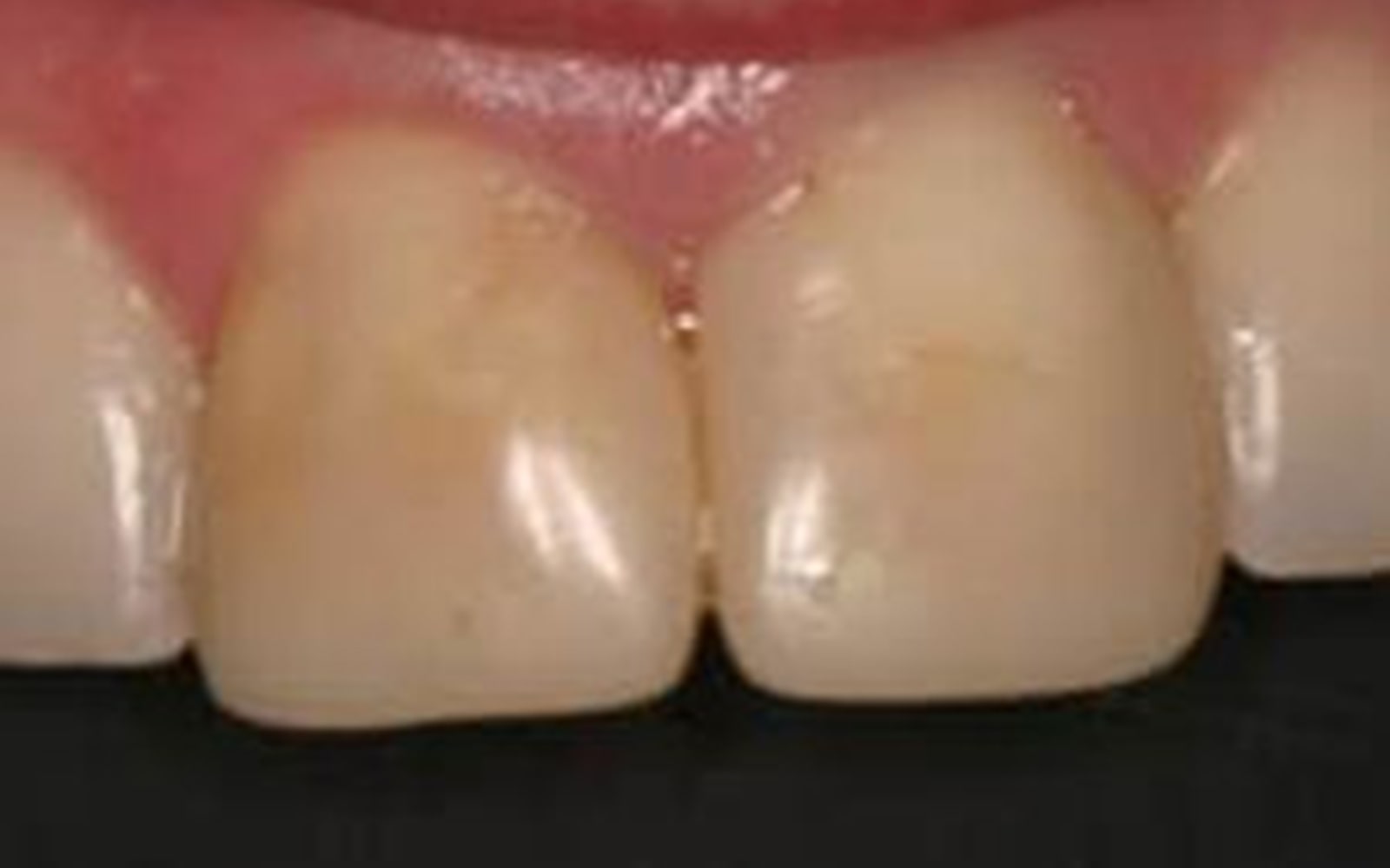 Crowns and Veneers case 2, before