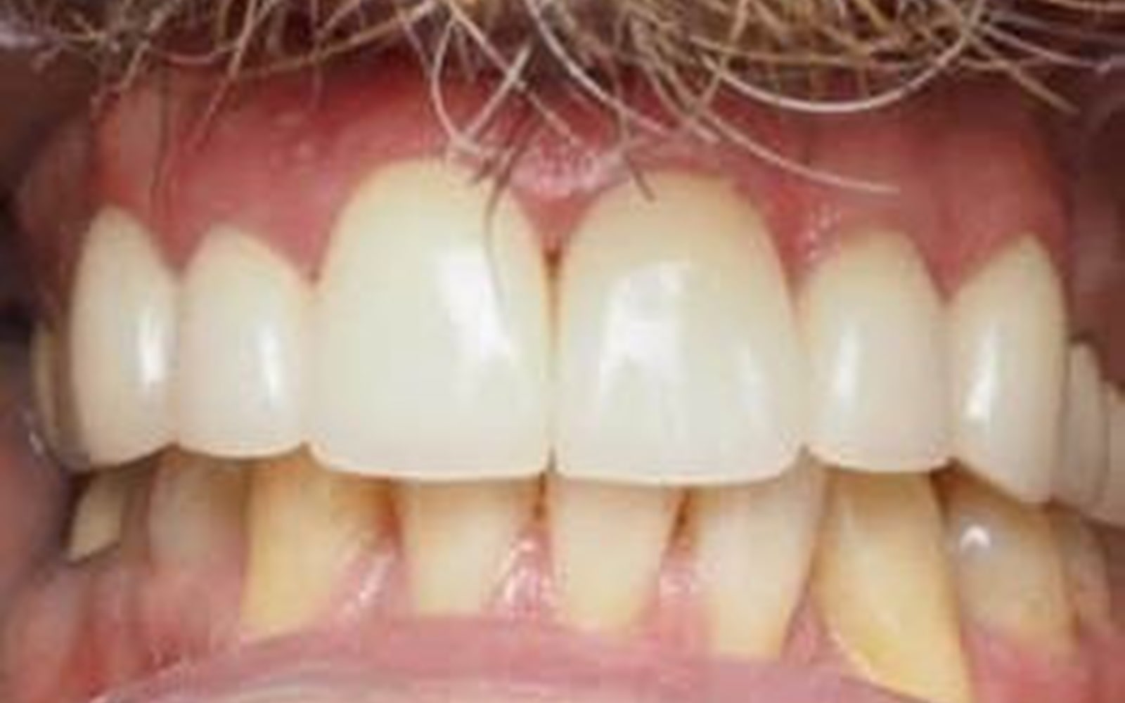 Crowns and Veneers case 3, after