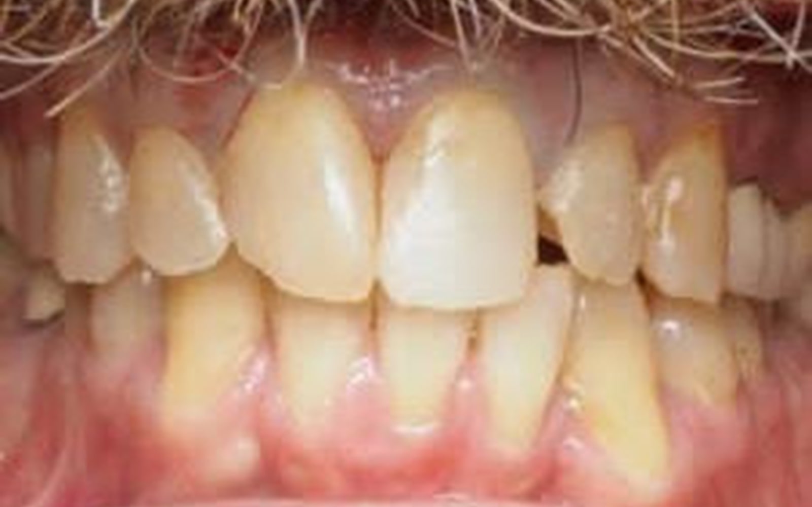 Crowns and Veneers case 3, before