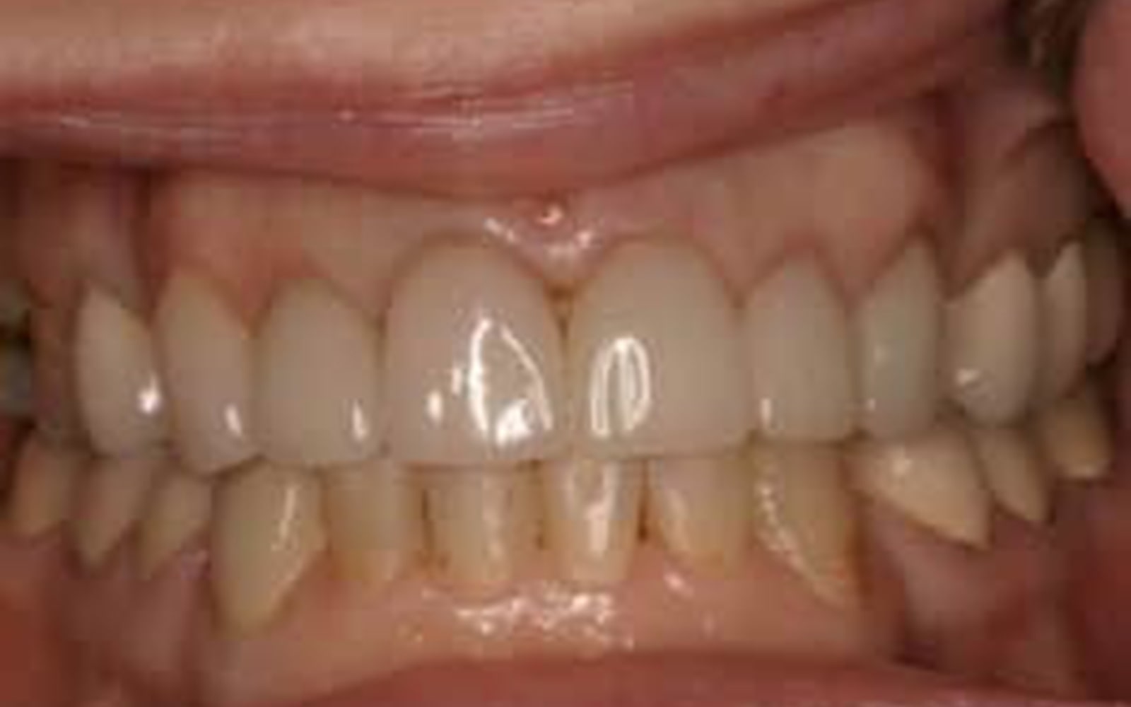 Crowns and Veneers case 4, after