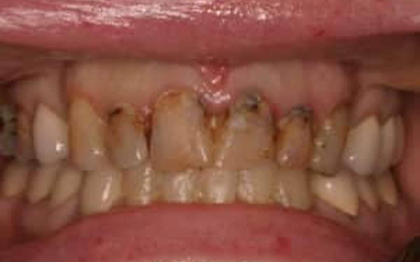 Crowns and Veneers case 4, before