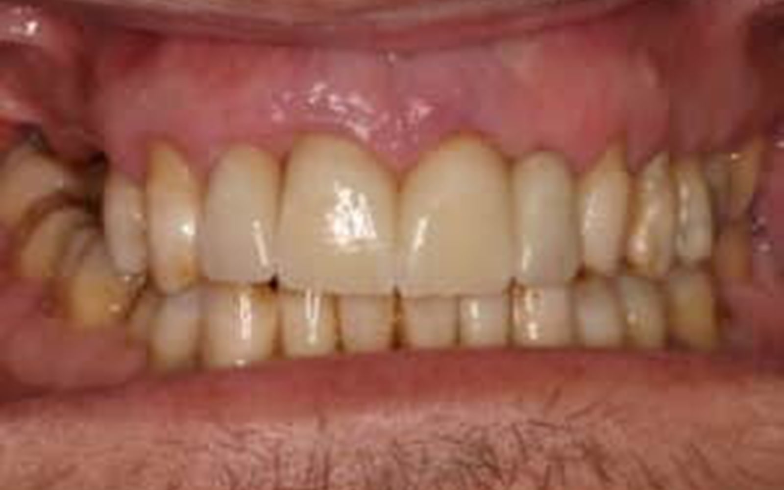 Crowns and Veneers case 5, after