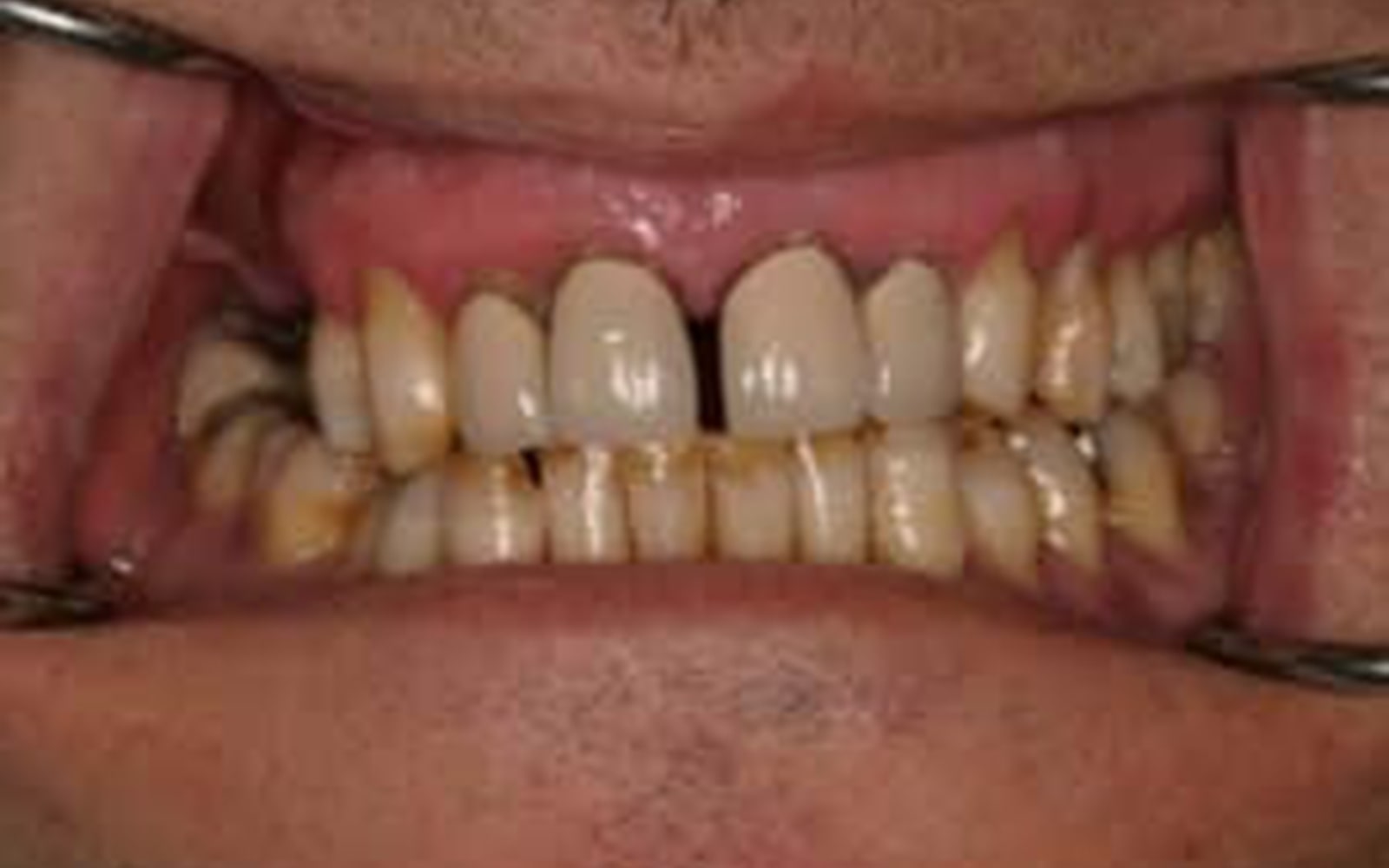 Crowns and Veneers case 5, before