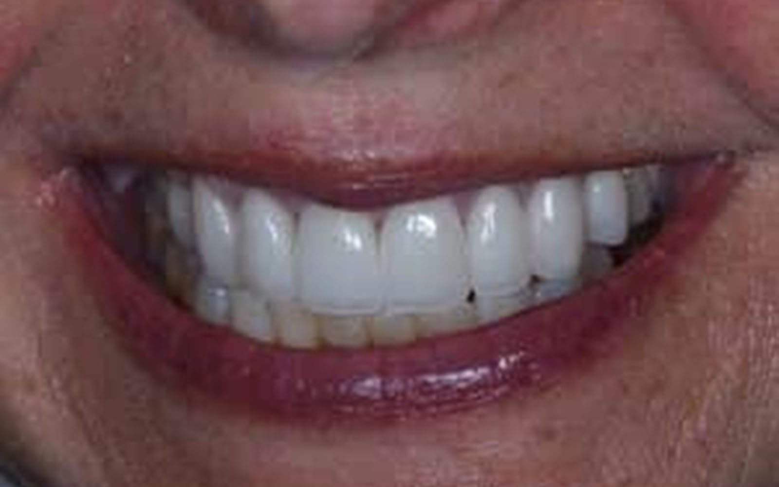 Crowns and Veneers case 6, after