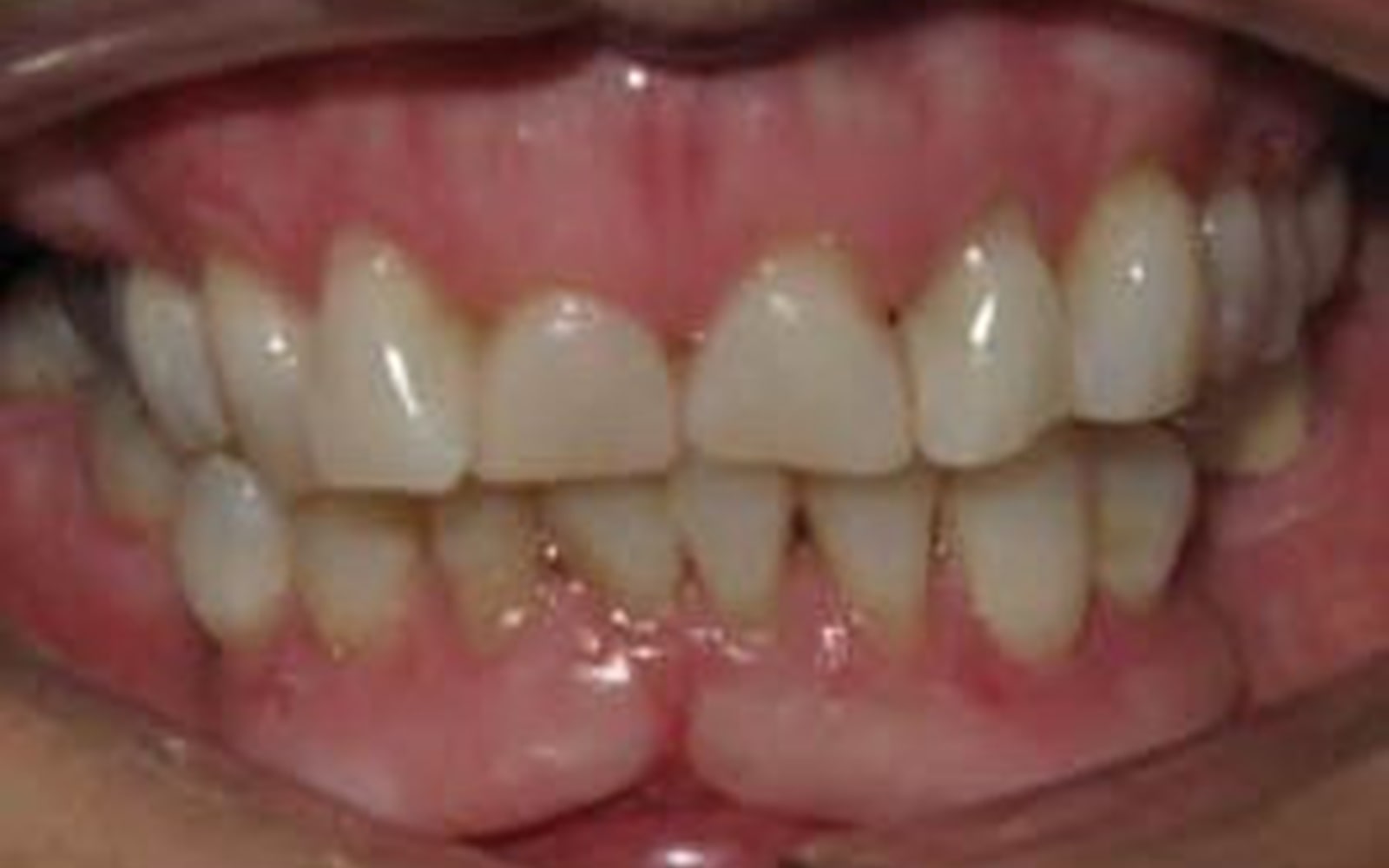 Crowns and Veneers case 6, before