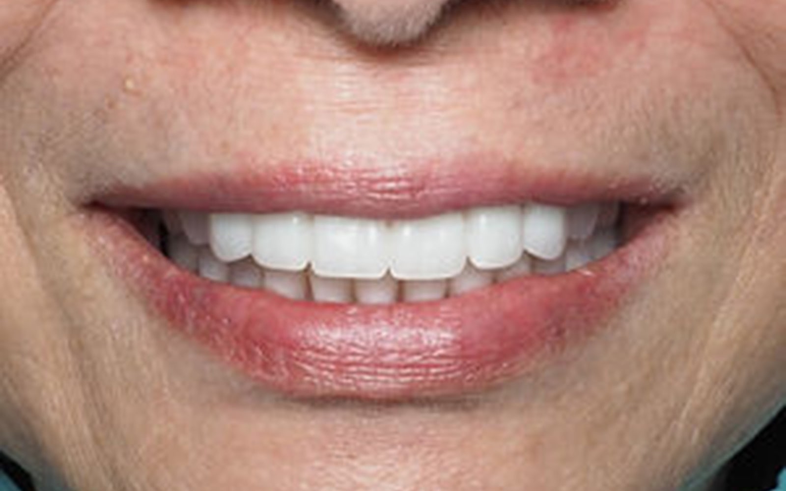Featured Transformations case 1, after