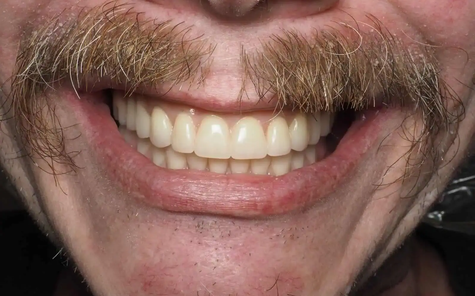 Featured Transformations case 2, after