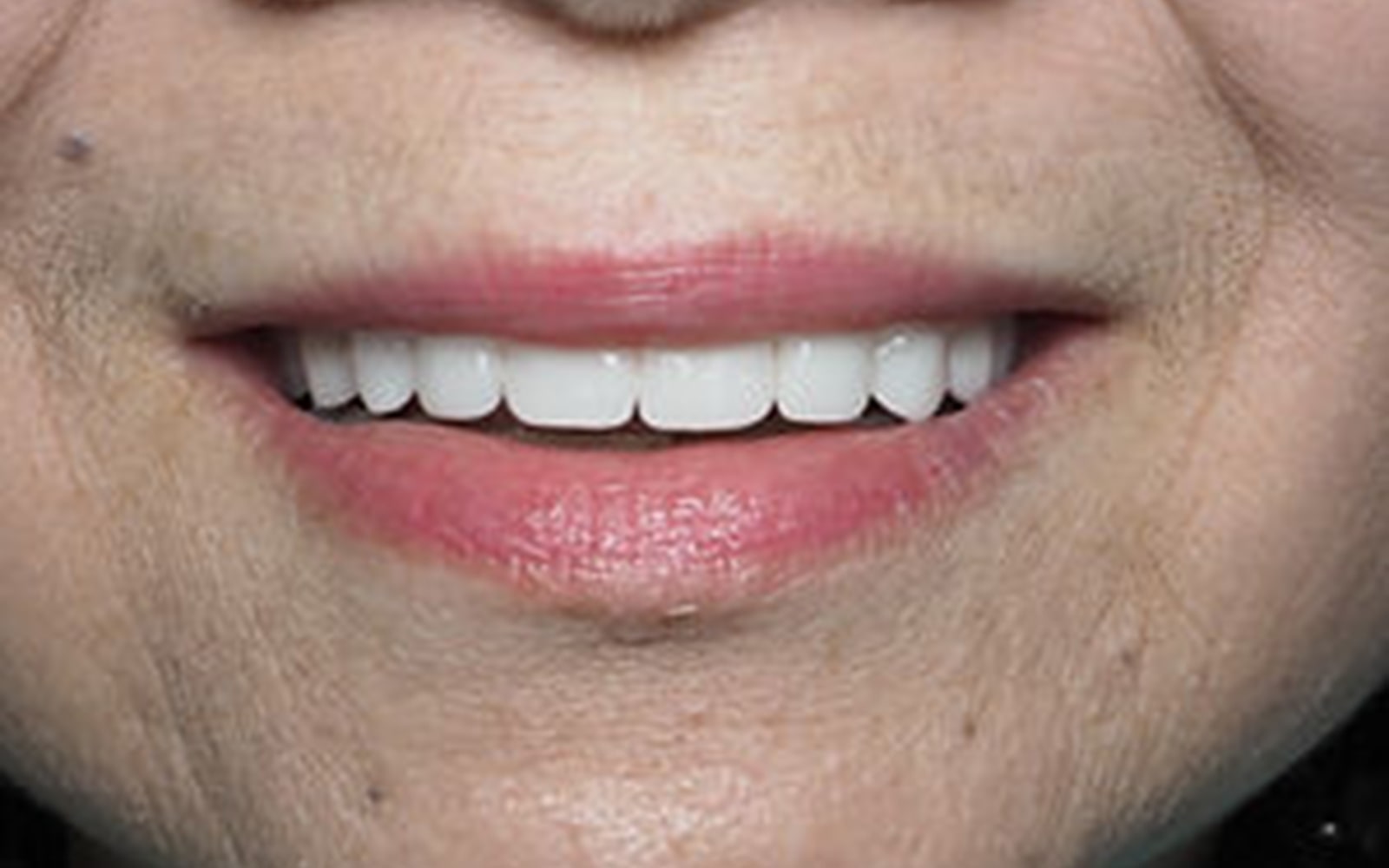 Full Mouth Reconstruction case 1, after