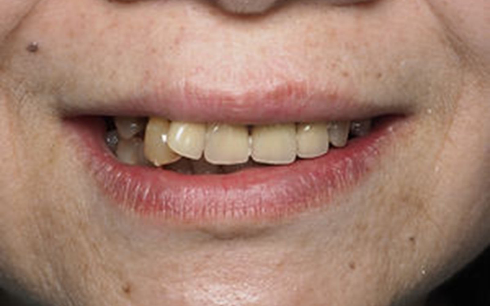 Full Mouth Reconstruction case 1, before