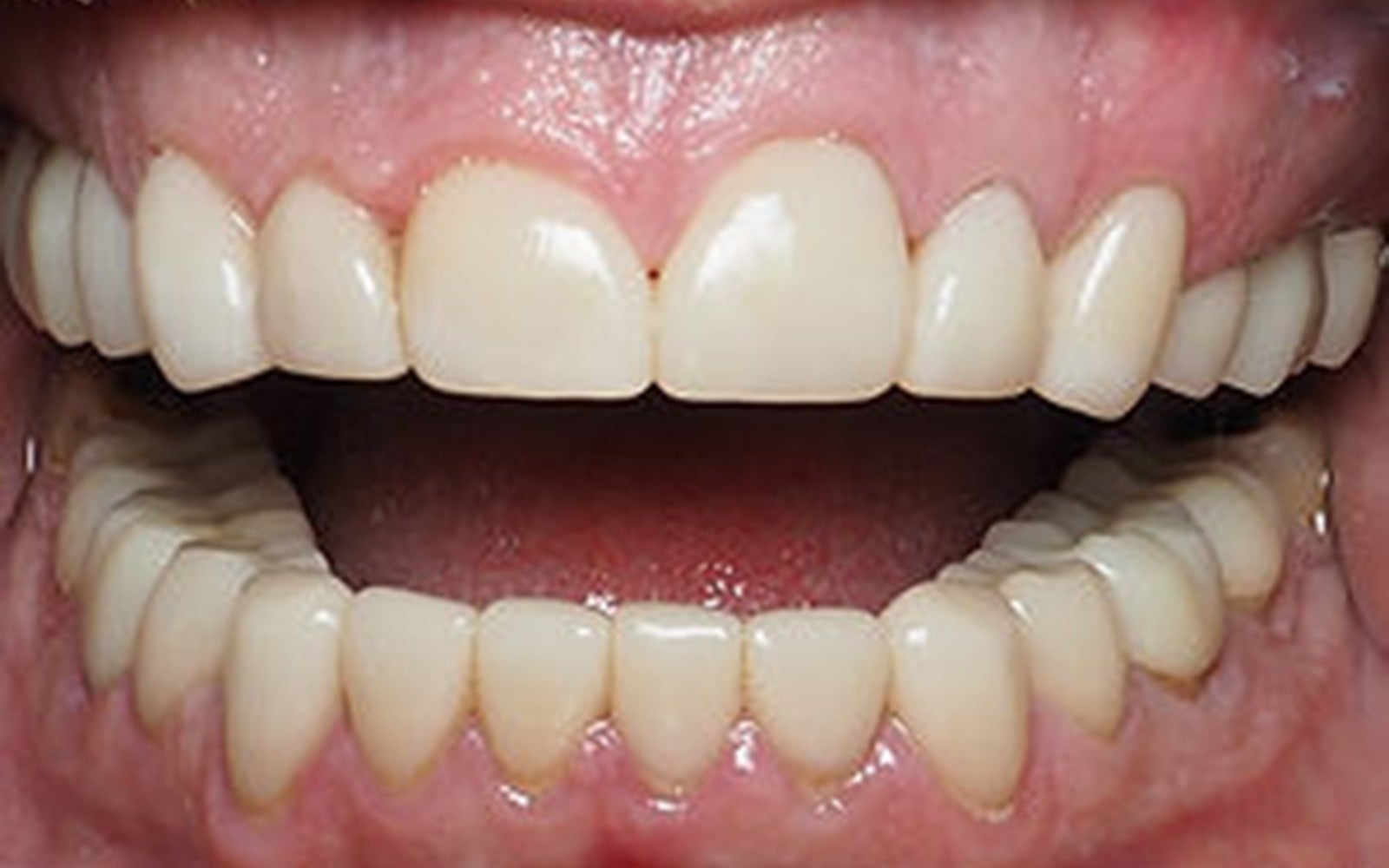 Full Mouth Reconstruction case 2, after