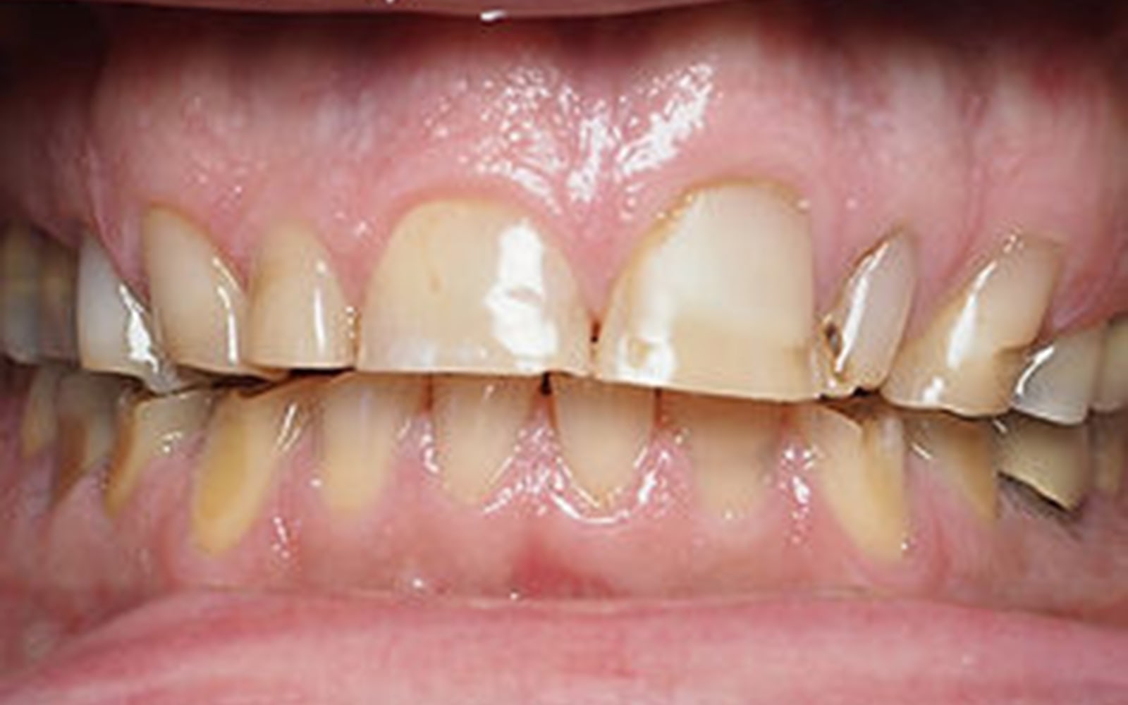 Full Mouth Reconstruction case 2, before