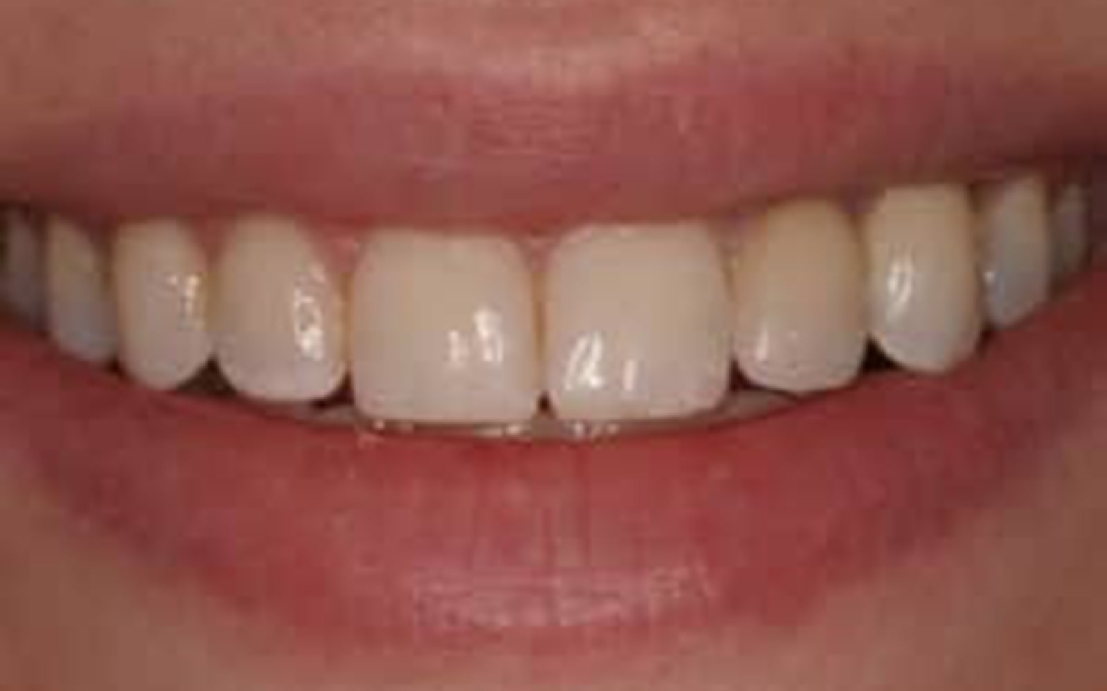 Dental Implants case 1, after