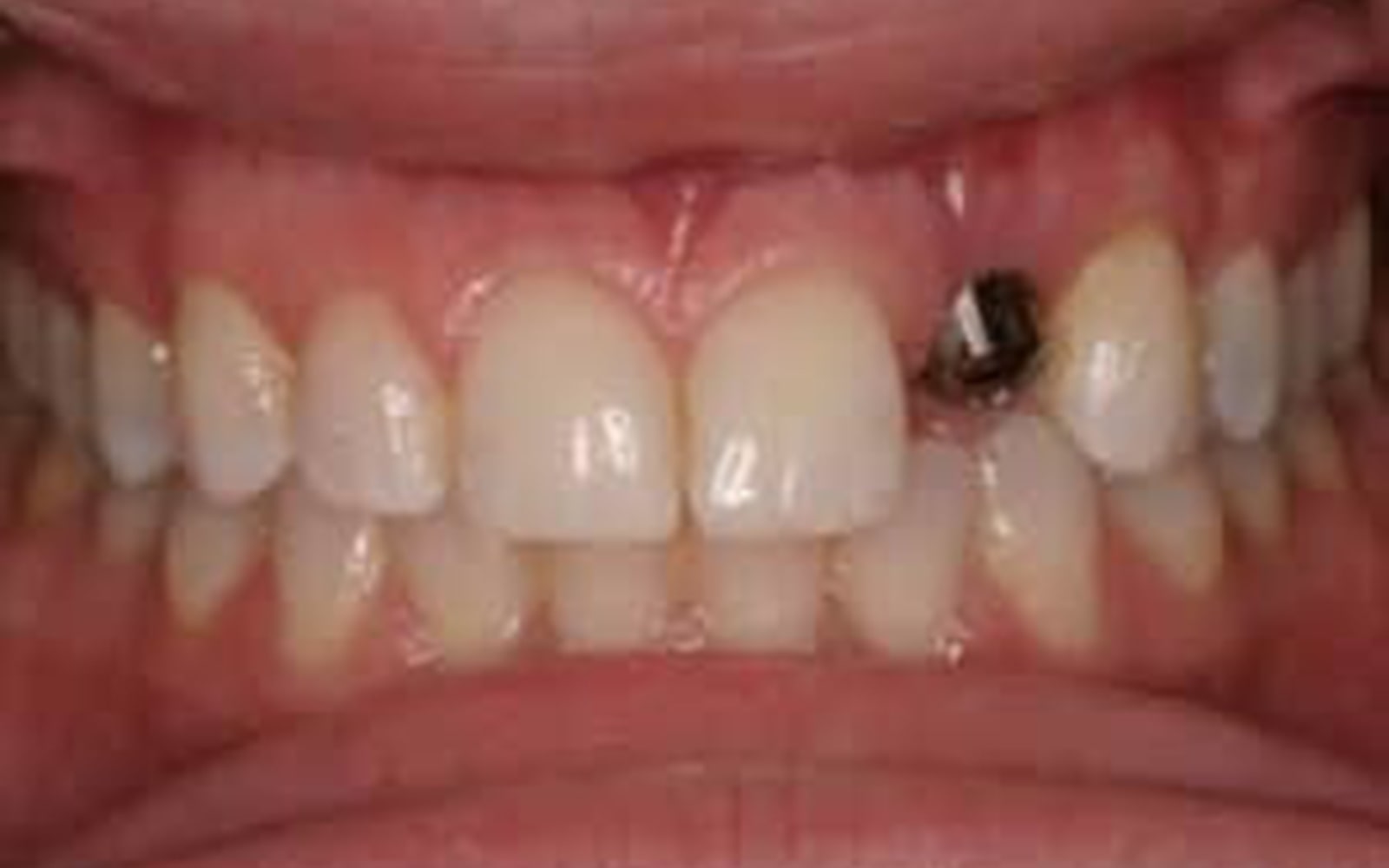 Dental Implants case 1, before