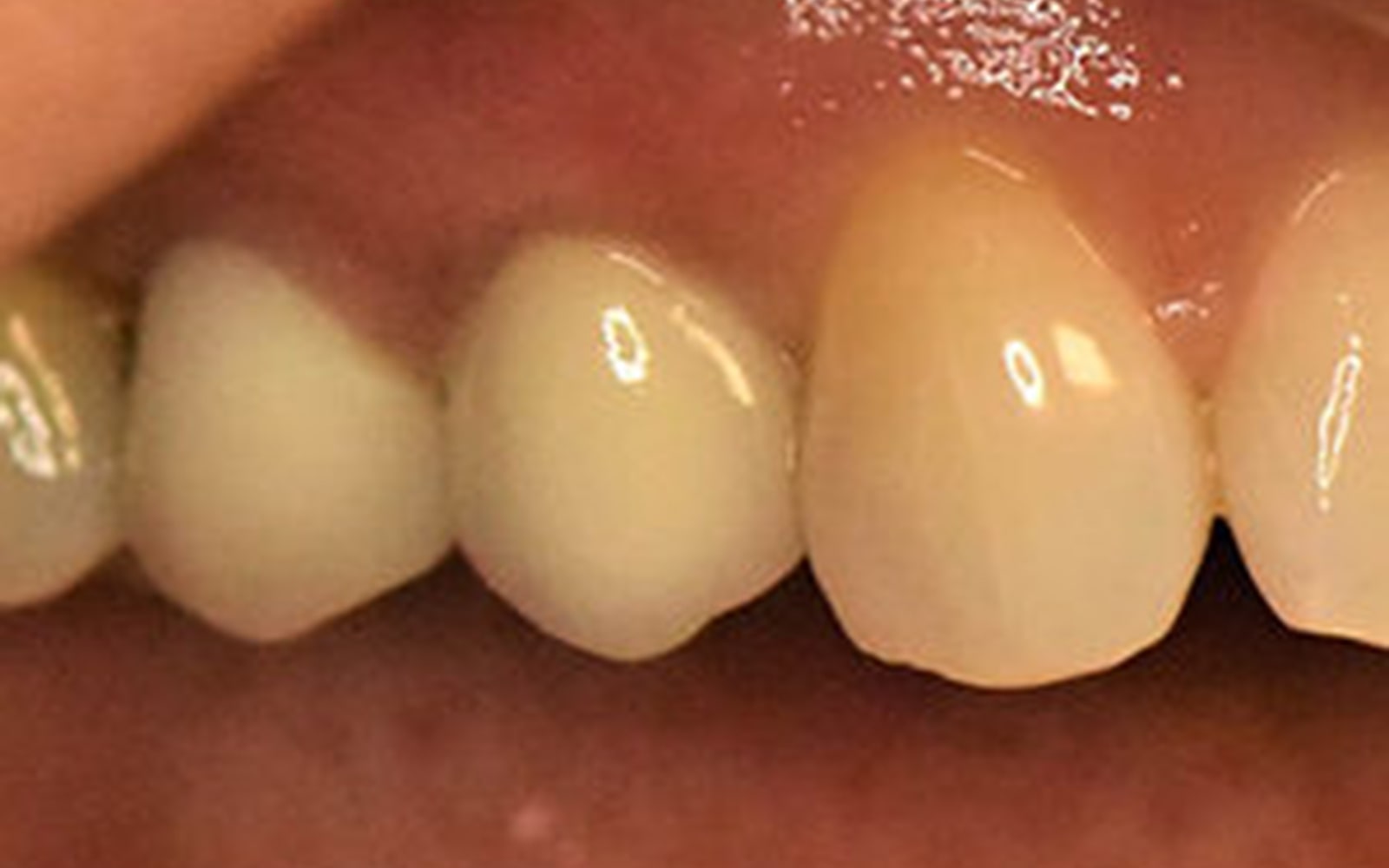 Dental Implants case 2, after