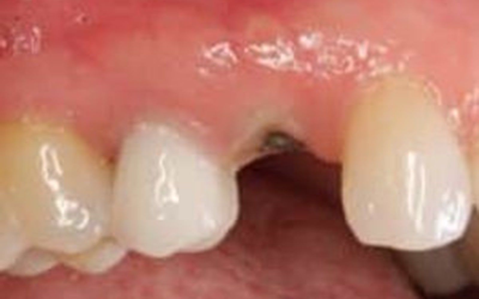 Dental Implants case 2, before