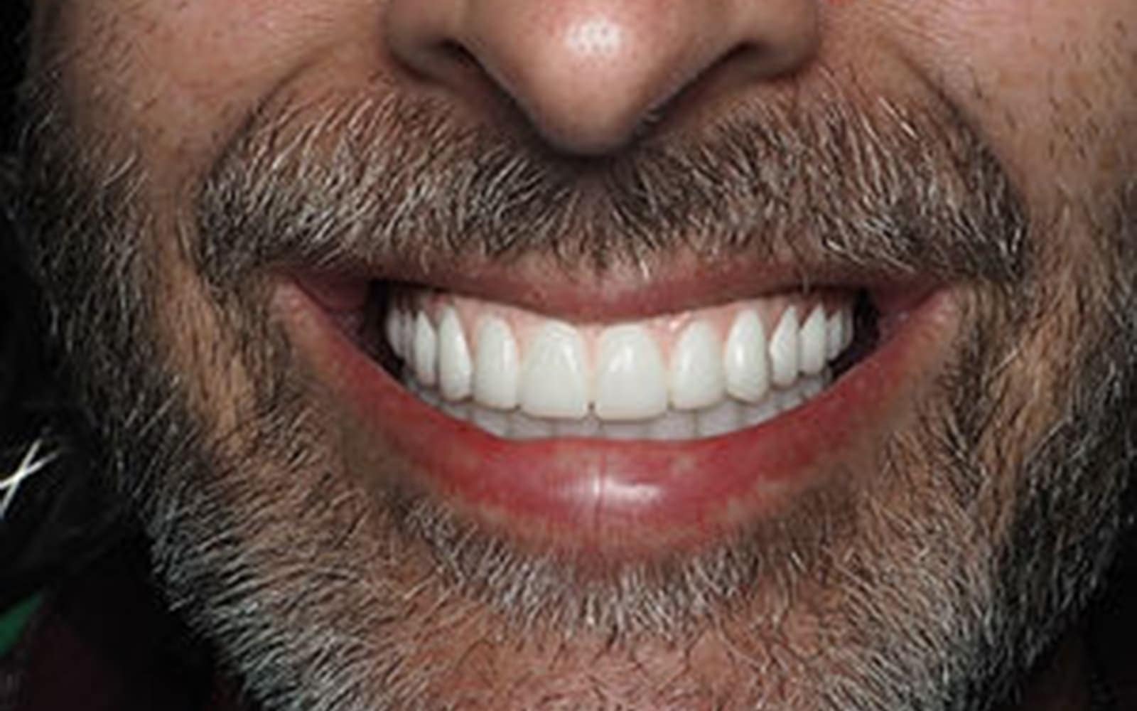 Dental Implants case 3, after
