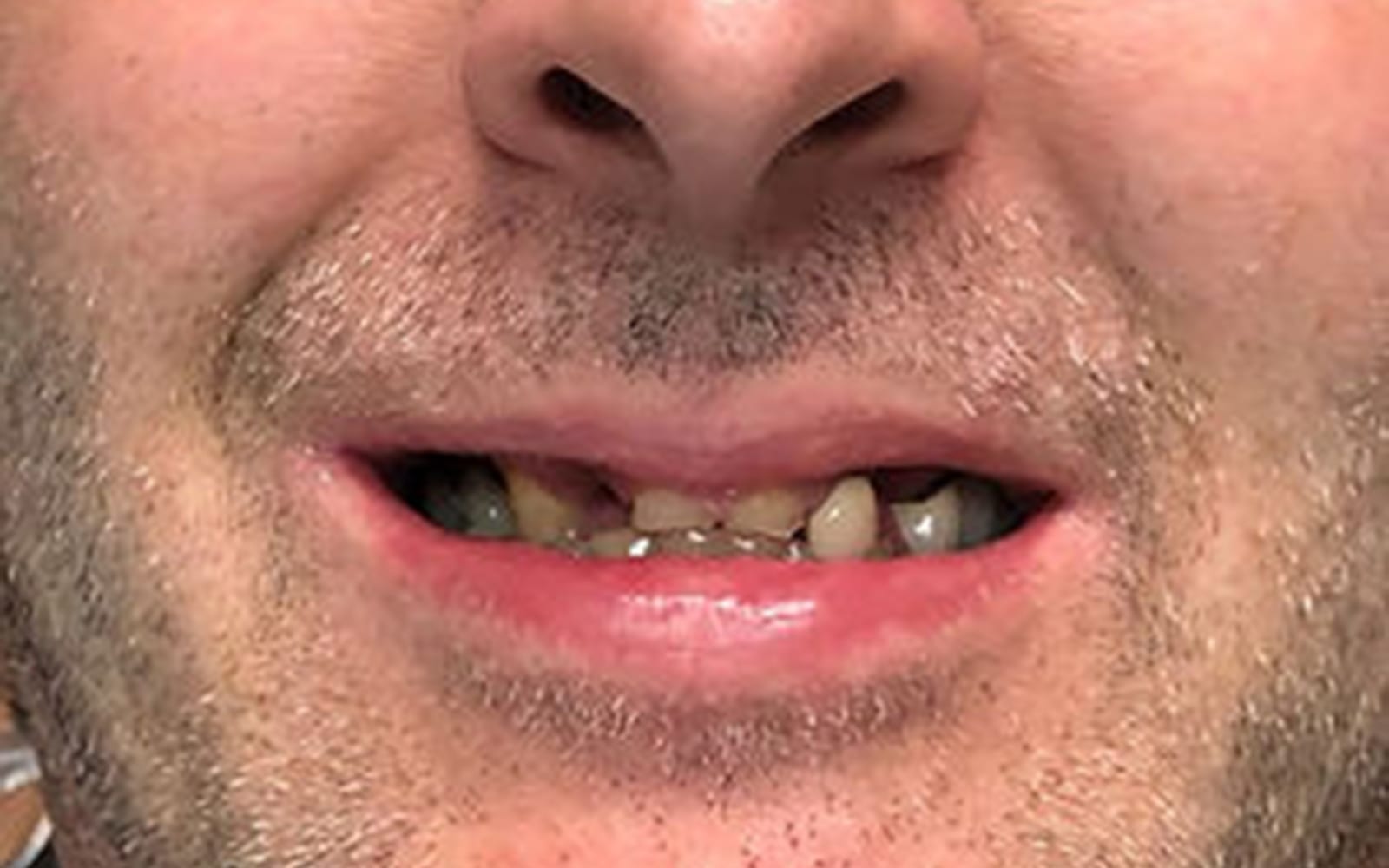 Dental Implants case 3, before