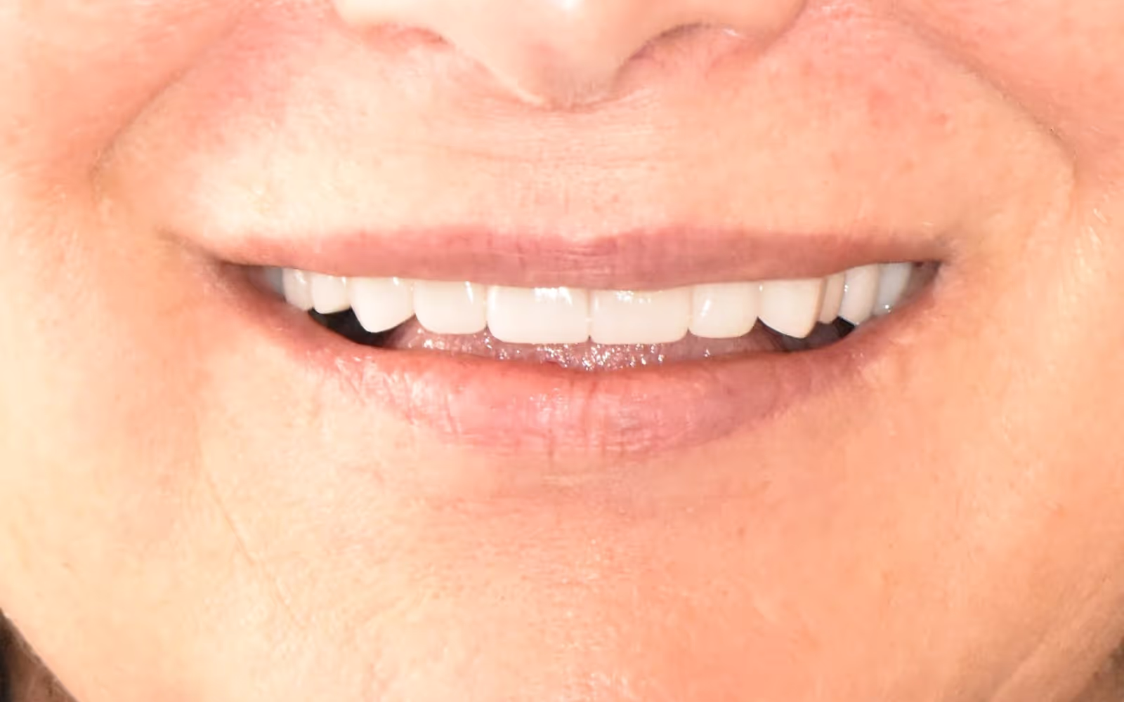 Smile Makeover with Crowns case 1, after