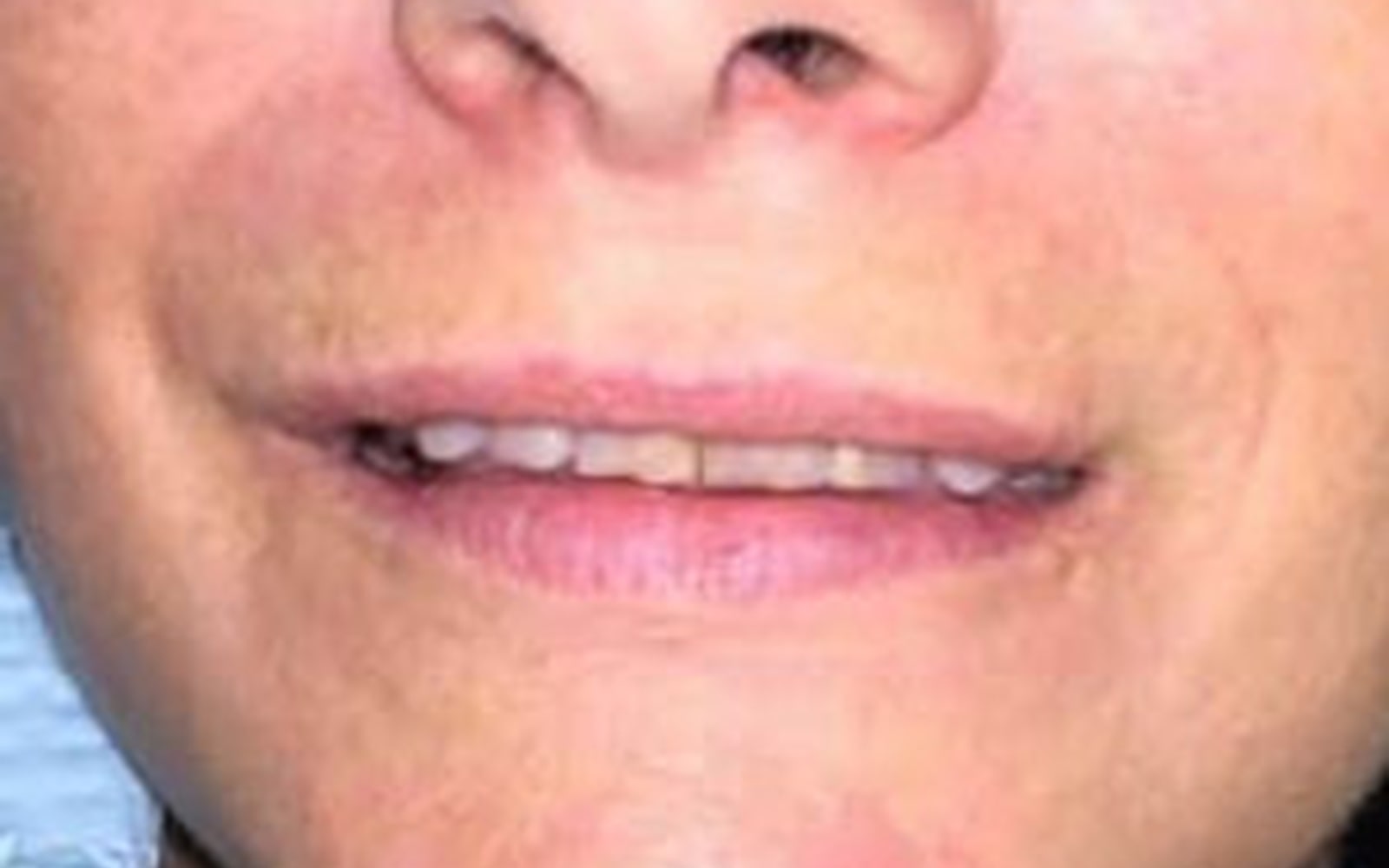 Smile Makeover with Crowns case 1, before
